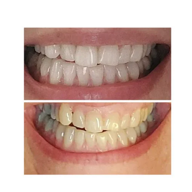 Teeth Whitening Strips