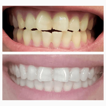 Teeth Whitening Strips